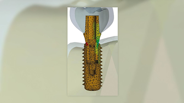 Darstellung eines Zahn-Implantats